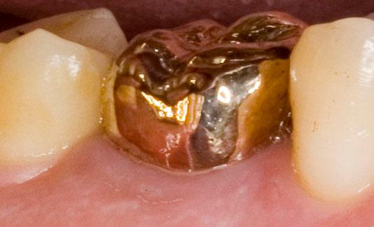 Bestand:Crown dentistry gold 03 lateral.jpg