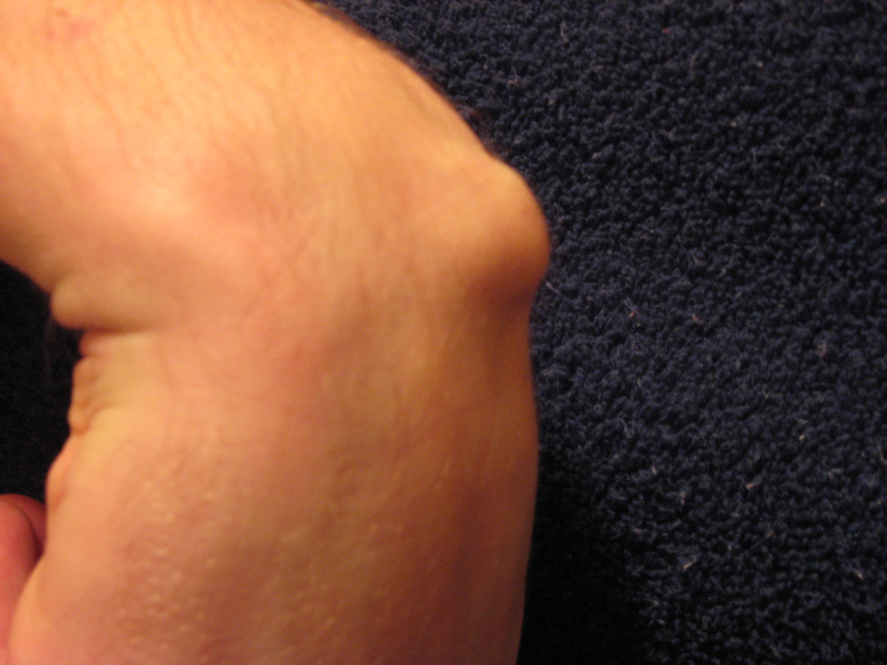 Bestand:Ganglion-cyst-2008.png