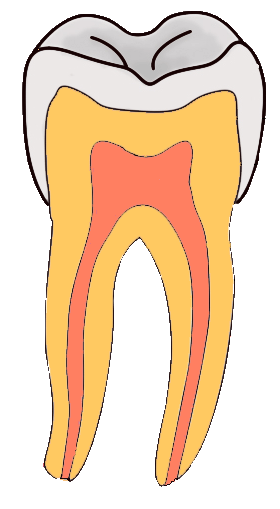 Bestand:Smooth Surface Caries GIF.gif